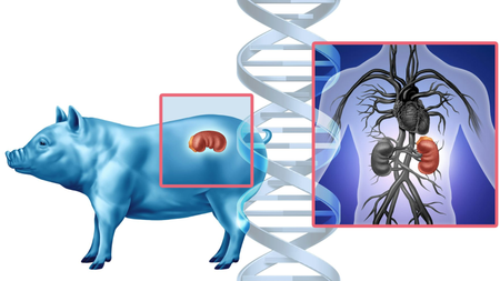 Pig Kidney Transplant concept as a genetically modified animal organ transferred to humans as Xenotransplantation technology or Xenogeneic transplantation as bioengineered DNA.